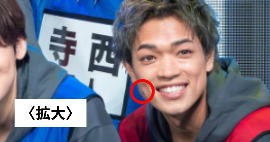 Timeleszの原嘉孝のほくろいつ取った？メイクで隠したのか整形なのか画像比較で調査